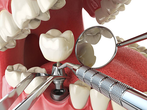 Best Emergency Treatment for Dental Infections or Abscesses in Stevenson, AL